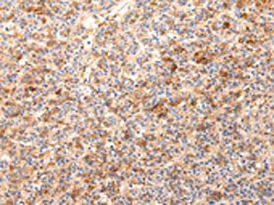 The image on the left is immunohistochemistry of paraffin-embedded Human liver cancer tissue using CSB-PA123199(ZNF365 Antibody) at dilution 1/20, on the right is treated with synthetic peptide. (Original magnification: ×200)