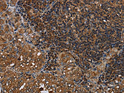 The image on the left is immunohistochemistry of paraffin-embedded Human thyroid cancer tissue using CSB-PA123223(HOMER2 Antibody) at dilution 1/40, on the right is treated with fusion protein. (Original magnification: ×200)