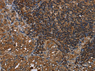 The image on the left is immunohistochemistry of paraffin-embedded Human thyroid cancer tissue using CSB-PA123223(HOMER2 Antibody) at dilution 1/40, on the right is treated with fusion protein. (Original magnification: ×200)