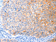 The image on the left is immunohistochemistry of paraffin-embedded Human cervical cancer tissue using CSB-PA123254(CCDC88A Antibody) at dilution 1/50, on the right is treated with synthetic peptide. (Original magnification: ×200)