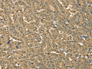 The image on the left is immunohistochemistry of paraffin-embedded Human thyroid cancer tissue using CSB-PA123862(PSMC1 Antibody) at dilution 1/25, on the right is treated with fusion protein. (Original magnification: ×200)