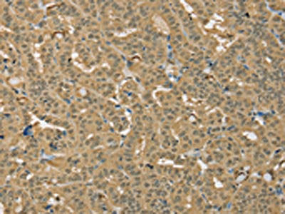 The image on the left is immunohistochemistry of paraffin-embedded Human thyroid cancer tissue using CSB-PA123862(PSMC1 Antibody) at dilution 1/25, on the right is treated with fusion protein. (Original magnification: ×200)
