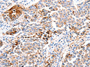The image on the left is immunohistochemistry of paraffin-embedded Human breast cancer tissue using CSB-PA123895(FOXD2 Antibody) at dilution 1/10, on the right is treated with synthetic peptide. (Original magnification: ×200)