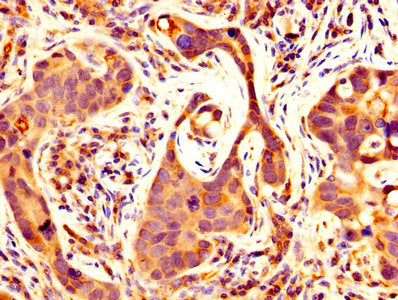 IHC image of CSB-PA12389A0Rb diluted at 1:500 and staining in paraffin-embedded human pancreatic cancer performed on a Leica BondTM system. After dewaxing and hydration, antigen retrieval was mediated by high pressure in a citrate buffer (pH 6.0)....
