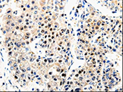 The image on the left is immunohistochemistry of paraffin-embedded Human liver cancer tissue using CSB-PA123968(APP Antibody) at dilution 1/100, on the right is treated with synthetic peptide. (Original magnification: ×200)
