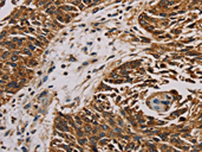 The image on the left is immunohistochemistry of paraffin-embedded Human lung cancer tissue using CSB-PA124380(MRPL11 Antibody) at dilution 1/20, on the right is treated with fusion protein. (Original magnification: ×200)