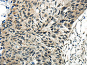 The image on the left is immunohistochemistry of paraffin-embedded Human esophagus cancer tissue using CSB-PA124592(SYNCRIP Antibody) at dilution 1/30, on the right is treated with synthetic peptide. (Original magnification: ×200)