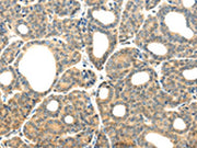 The image on the left is immunohistochemistry of paraffin-embedded Human thyroid cancer tissue using CSB-PA124601(PLXNB2 Antibody) at dilution 1/20, on the right is treated with synthetic peptide. (Original magnification: ×200)