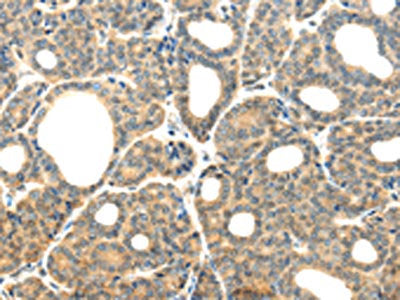 The image on the left is immunohistochemistry of paraffin-embedded Human thyroid cancer tissue using CSB-PA124601(PLXNB2 Antibody) at dilution 1/20, on the right is treated with synthetic peptide. (Original magnification: ×200)