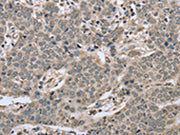 The image on the left is immunohistochemistry of paraffin-embedded Human liver cancer tissue using CSB-PA124825(RHEB Antibody) at dilution 1/40, on the right is treated with synthetic peptide. (Original magnification: ×200)