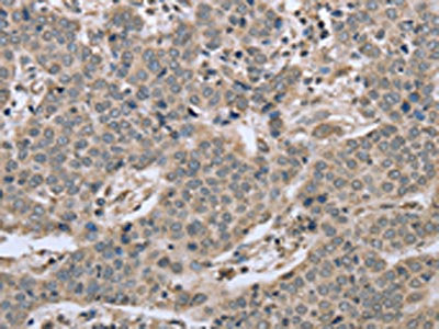 The image on the left is immunohistochemistry of paraffin-embedded Human liver cancer tissue using CSB-PA124825(RHEB Antibody) at dilution 1/40, on the right is treated with synthetic peptide. (Original magnification: ×200)