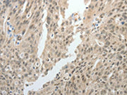 The image on the left is immunohistochemistry of paraffin-embedded Human ovarian cancer tissue using CSB-PA125082(TOP1MT Antibody) at dilution 1/15, on the right is treated with synthetic peptide. (Original magnification: ×200)