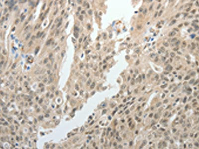 The image on the left is immunohistochemistry of paraffin-embedded Human ovarian cancer tissue using CSB-PA125082(TOP1MT Antibody) at dilution 1/15, on the right is treated with synthetic peptide. (Original magnification: ×200)