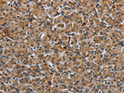 The image on the left is immunohistochemistry of paraffin-embedded Human prostate cancer tissue using CSB-PA125161(IL31RA Antibody) at dilution 1/30, on the right is treated with fusion protein. (Original magnification: ×200)