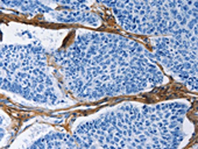 The image on the left is immunohistochemistry of paraffin-embedded Human lung cancer tissue using CSB-PA125350(COL3A1 Antibody) at dilution 1/60, on the right is treated with fusion protein. (Original magnification: ×200)