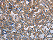 The image on the left is immunohistochemistry of paraffin-embedded Human thyroid cancer tissue using CSB-PA125511(POMT1 Antibody) at dilution 1/50, on the right is treated with synthetic peptide. (Original magnification: ×200)