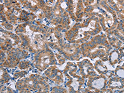 The image on the left is immunohistochemistry of paraffin-embedded Human thyroid cancer tissue using CSB-PA125511(POMT1 Antibody) at dilution 1/50, on the right is treated with synthetic peptide. (Original magnification: ×200)