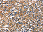 The image on the left is immunohistochemistry of paraffin-embedded Human thyroid cancer tissue using CSB-PA125715(CDC23 Antibody) at dilution 1/70, on the right is treated with synthetic peptide. (Original magnification: ×200)