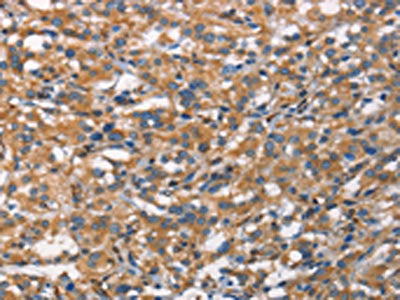 The image on the left is immunohistochemistry of paraffin-embedded Human thyroid cancer tissue using CSB-PA125715(CDC23 Antibody) at dilution 1/70, on the right is treated with synthetic peptide. (Original magnification: ×200)