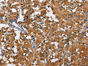 The image on the left is immunohistochemistry of paraffin-embedded Human thyroid cancer tissue using CSB-PA126129(KLF7 Antibody) at dilution 1/60, on the right is treated with fusion protein. (Original magnification: ×200)