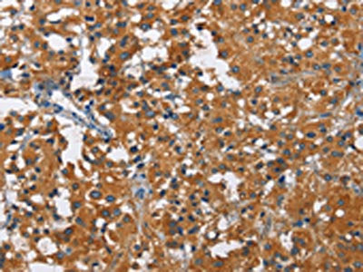 The image on the left is immunohistochemistry of paraffin-embedded Human thyroid cancer tissue using CSB-PA126129(KLF7 Antibody) at dilution 1/60, on the right is treated with fusion protein. (Original magnification: ×200)