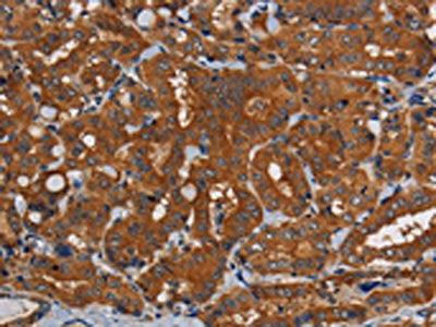 The image on the left is immunohistochemistry of paraffin-embedded Human thyroid cancer tissue using CSB-PA126186(PDE5A Antibody) at dilution 1/50, on the right is treated with synthetic peptide. (Original magnification: ×200)