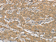 The image on the left is immunohistochemistry of paraffin-embedded Human gastic cancer tissue using CSB-PA126192(AMZ2 Antibody) at dilution 1/60, on the right is treated with fusion protein. (Original magnification: ×200)