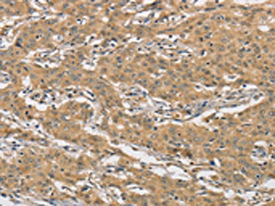 The image on the left is immunohistochemistry of paraffin-embedded Human gastic cancer tissue using CSB-PA126192(AMZ2 Antibody) at dilution 1/60, on the right is treated with fusion protein. (Original magnification: ×200)