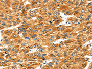 The image on the left is immunohistochemistry of paraffin-embedded Human liver cancer tissue using CSB-PA126337(STXBP4 Antibody) at dilution 1/40, on the right is treated with fusion protein. (Original magnification: ×200)