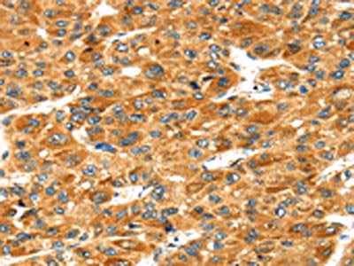 The image on the left is immunohistochemistry of paraffin-embedded Human liver cancer tissue using CSB-PA126337(STXBP4 Antibody) at dilution 1/40, on the right is treated with fusion protein. (Original magnification: ×200)