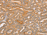 The image on the left is immunohistochemistry of paraffin-embedded Human thyroid cancer tissue using CSB-PA126362(CD2AP Antibody) at dilution 1/70, on the right is treated with synthetic peptide. (Original magnification: ×200)