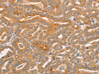 The image on the left is immunohistochemistry of paraffin-embedded Human thyroid cancer tissue using CSB-PA126362(CD2AP Antibody) at dilution 1/70, on the right is treated with synthetic peptide. (Original magnification: ×200)