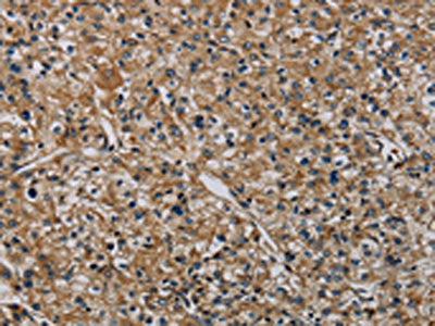 The image on the left is immunohistochemistry of paraffin-embedded Human prostate cancer tissue using CSB-PA126539(HSPG2 Antibody) at dilution 1/50, on the right is treated with synthetic peptide. (Original magnification: ×200)