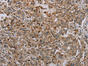 The image on the left is immunohistochemistry of paraffin-embedded Human liver cancer tissue using CSB-PA126562(ERRFI1 Antibody) at dilution 1/35, on the right is treated with synthetic peptide. (Original magnification: ×200)