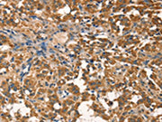 The image on the left is immunohistochemistry of paraffin-embedded Human thyroid cancer tissue using CSB-PA126592(AGO1 Antibody) at dilution 1/40, on the right is treated with synthetic peptide. (Original magnification: ×200)
