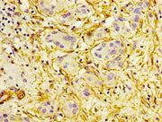 IHC image of CSB-PA12659A0Rb diluted at 1:300 and staining in paraffin-embedded human liver cancer performed on a Leica BondTM system. After dewaxing and hydration, antigen retrieval was mediated by high pressure in a citrate buffer (pH 6.0). Sect...