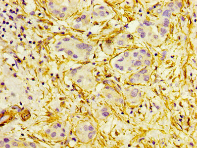 IHC image of CSB-PA12659A0Rb diluted at 1:300 and staining in paraffin-embedded human liver cancer performed on a Leica BondTM system. After dewaxing and hydration, antigen retrieval was mediated by high pressure in a citrate buffer (pH 6.0). Sect...