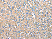 The image on the left is immunohistochemistry of paraffin-embedded Human liver cancer tissue using CSB-PA126671(VAPA Antibody) at dilution 1/30, on the right is treated with fusion protein. (Original magnification: ×200)
