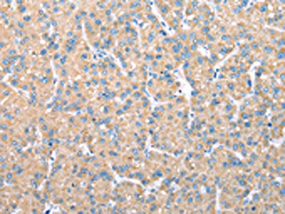 The image on the left is immunohistochemistry of paraffin-embedded Human liver cancer tissue using CSB-PA126671(VAPA Antibody) at dilution 1/30, on the right is treated with fusion protein. (Original magnification: ×200)