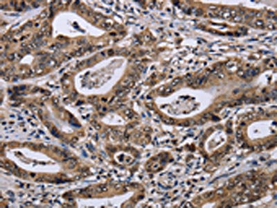 The image on the left is immunohistochemistry of paraffin-embedded Human gastic cancer tissue using CSB-PA126732(DUSP4 Antibody) at dilution 1/40, on the right is treated with fusion protein. (Original magnification: ×200)