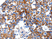 The image on the left is immunohistochemistry of paraffin-embedded Human breast cancer tissue using CSB-PA126836(CLEC7A Antibody) at dilution 1/5, on the right is treated with fusion protein. (Original magnification: ×200)