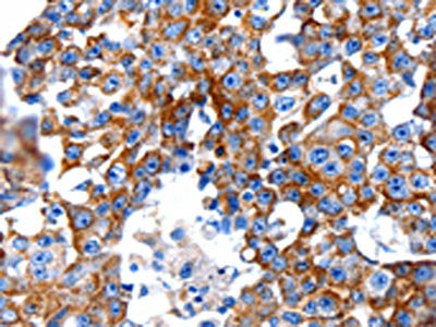 The image on the left is immunohistochemistry of paraffin-embedded Human breast cancer tissue using CSB-PA126836(CLEC7A Antibody) at dilution 1/5, on the right is treated with fusion protein. (Original magnification: ×200)