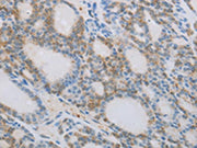 The image on the left is immunohistochemistry of paraffin-embedded Human thyroid cancer tissue using CSB-PA126963(NCK2 Antibody) at dilution 1/60, on the right is treated with synthetic peptide. (Original magnification: ×200)