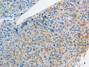 The image on the left is immunohistochemistry of paraffin-embedded Human liver cancer tissue using CSB-PA127030(IL27 Antibody) at dilution 1/15, on the right is treated with fusion protein. (Original magnification: ×200)