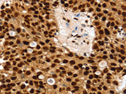 The image on the left is immunohistochemistry of paraffin-embedded Human breast cancer tissue using CSB-PA127171(SSB Antibody) at dilution 1/30, on the right is treated with synthetic peptide. (Original magnification: ×200)