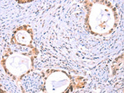 The image on the left is immunohistochemistry of paraffin-embedded Human cervical cancer tissue using CSB-PA127412(PROS1 Antibody) at dilution 1/60, on the right is treated with fusion protein. (Original magnification: ×200)