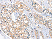 The image on the left is immunohistochemistry of paraffin-embedded Human breast cancer tissue using CSB-PA127416(FAIM3 Antibody) at dilution 1/20, on the right is treated with fusion protein. (Original magnification: ×200)