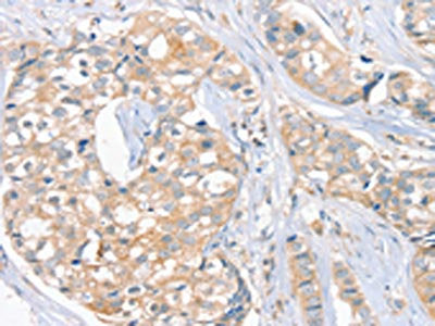 The image on the left is immunohistochemistry of paraffin-embedded Human breast cancer tissue using CSB-PA127416(FAIM3 Antibody) at dilution 1/20, on the right is treated with fusion protein. (Original magnification: ×200)