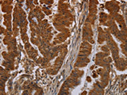 The image on the left is immunohistochemistry of paraffin-embedded Human esophagus cancer tissue using CSB-PA127552(NPRL2 Antibody) at dilution 1/40, on the right is treated with synthetic peptide. (Original magnification: ×200)