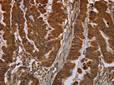 The image on the left is immunohistochemistry of paraffin-embedded Human esophagus cancer tissue using CSB-PA127552(NPRL2 Antibody) at dilution 1/40, on the right is treated with synthetic peptide. (Original magnification: ×200)